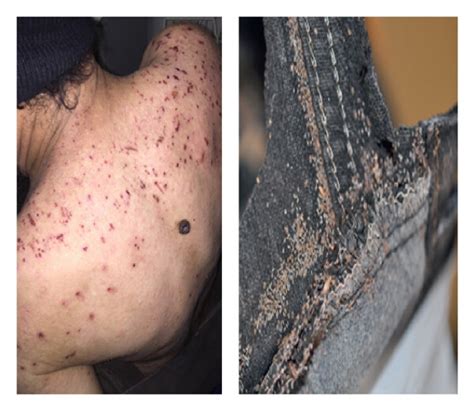 Management and Treatment of Human Lice .
